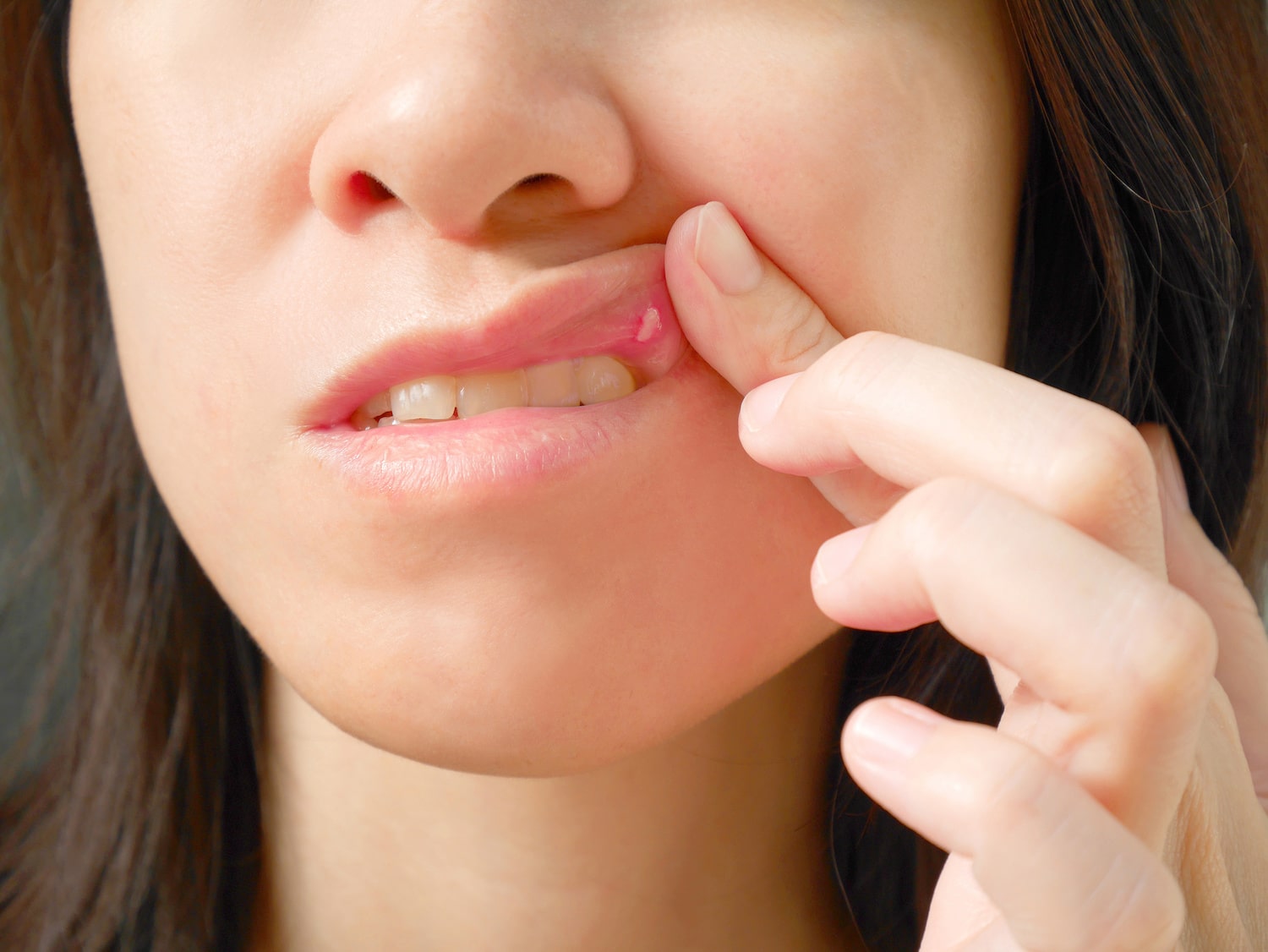 Overview of Canker Sores, Cold Sores \u0026 Treatments - freeCE, image size:1500x1126